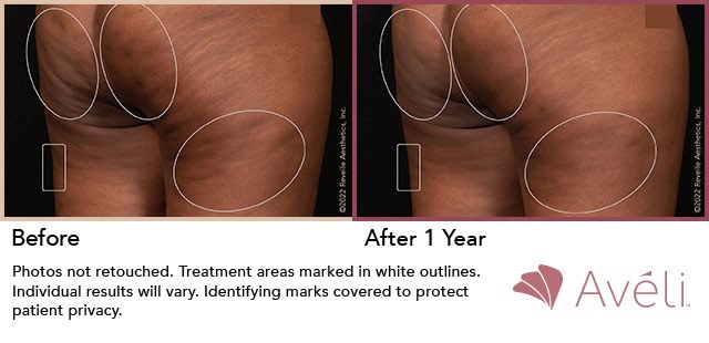 Aveli before and after, one year, buttocks and thigh cellulite reduction