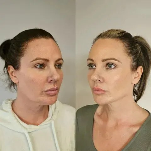 Before and after results of EndoLift non-surgical skin tightening
