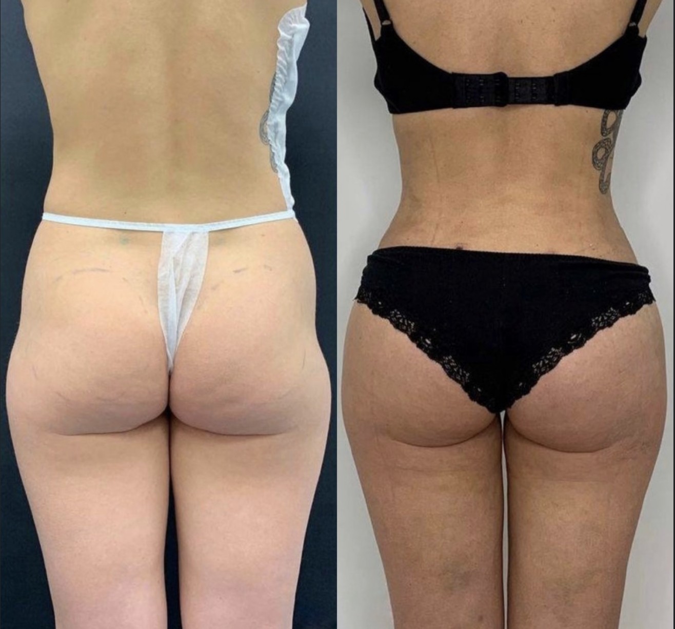 Before and after results of hip dip correction