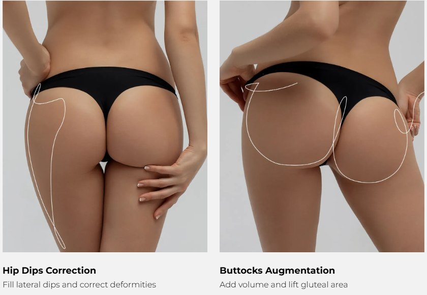 Diagram showing hip dip correction and buttocks augmentation treatment areas