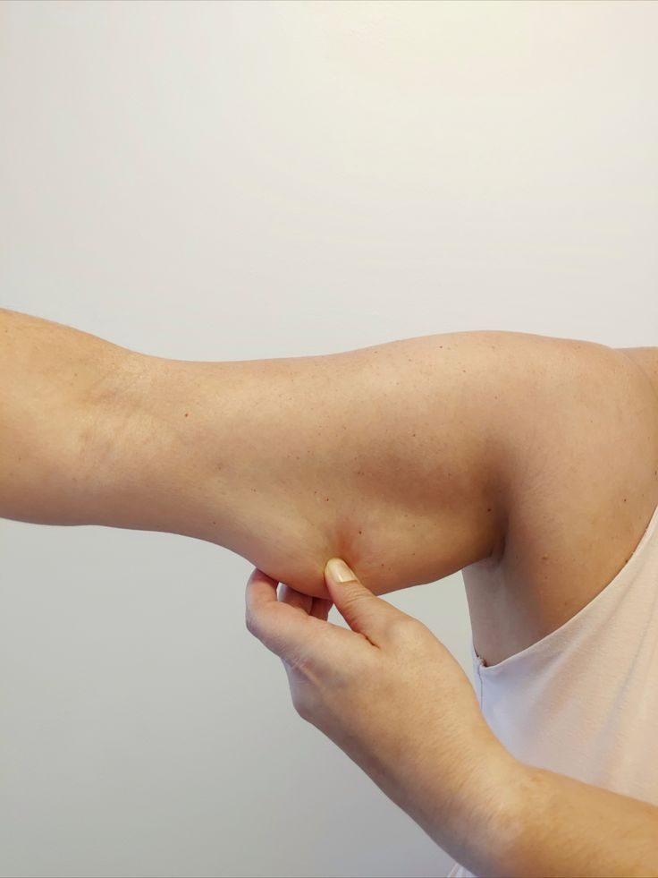 Close-up of upper arm skin targeted for Smart Lipo arm contouring