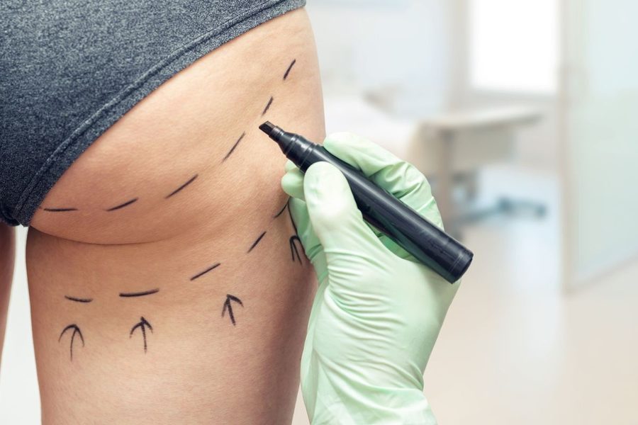 Before and after results of a non-surgical Brazilian Butt Lift