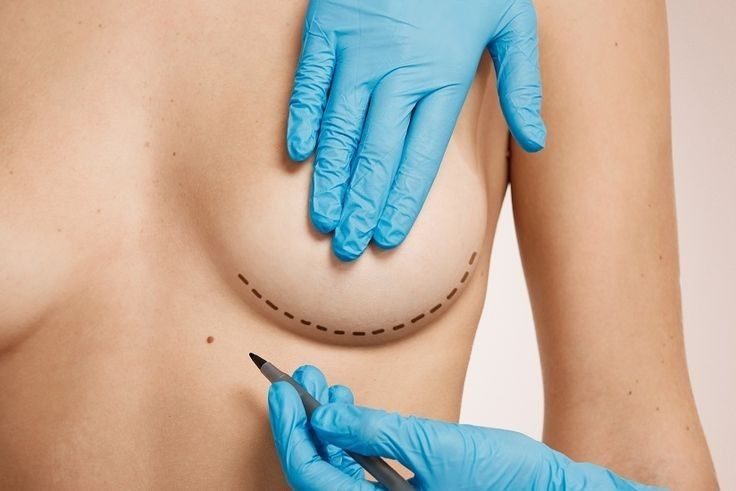 Physician marking the treatment area for a non-surgical PRF breast lift