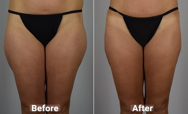 Before and after results of Thigh Smart Lipo treatment